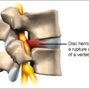 Cervical Disc Herniation-3