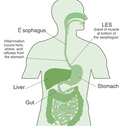 reflux esophagitis