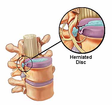 jedi_Cervical Disc Herniation.jpg