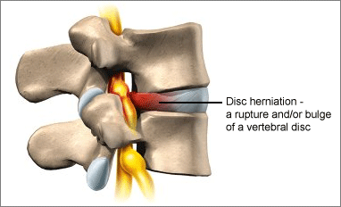 jedi_Cervical Disc Herniation_091025.png