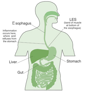 jedi_reflux esophagitis.jpg